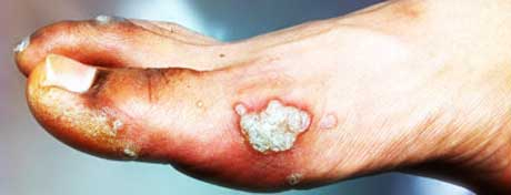 warts homeopathic treatment in Dubai
