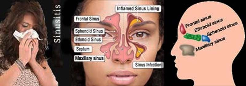 sinusitis