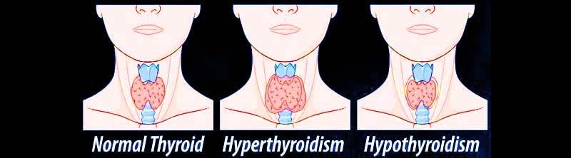 Thyroid