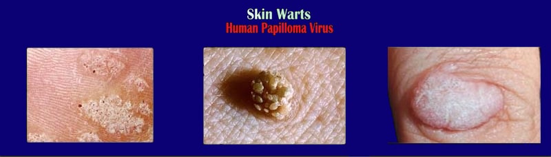 warts